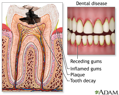 Tooth Decay vs. Cavity: What’s the Difference?