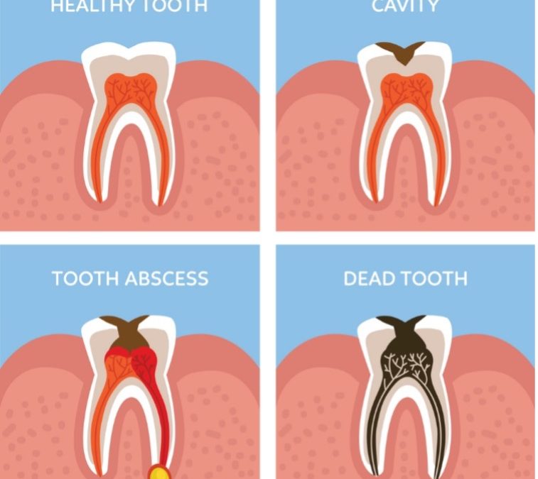 Do You Need a Root Canal? When a Cavity Becomes Serious