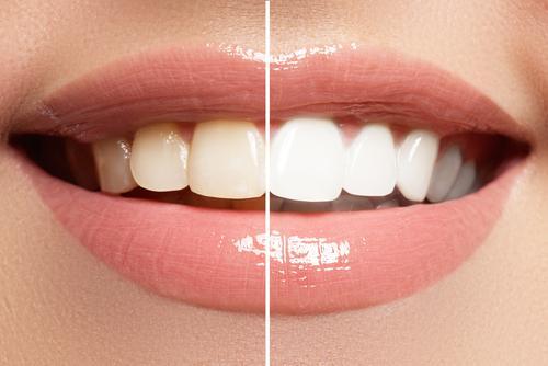 teeth color