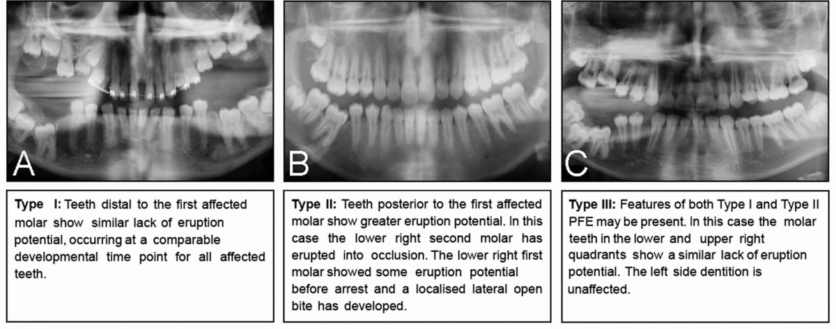 # What Are the Functions of Molars vs. Incisors?