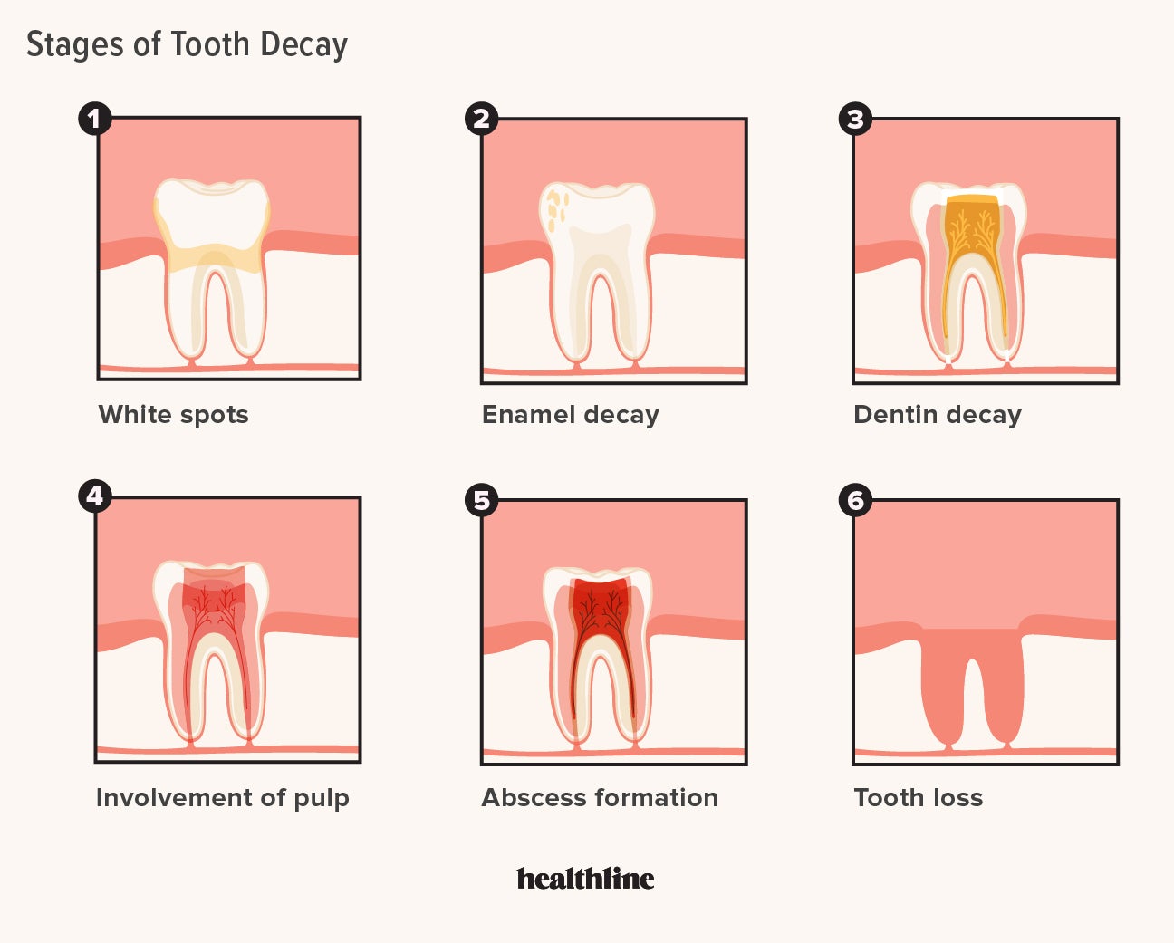 Tooth Decay vs. Cavity: What’s the Difference?