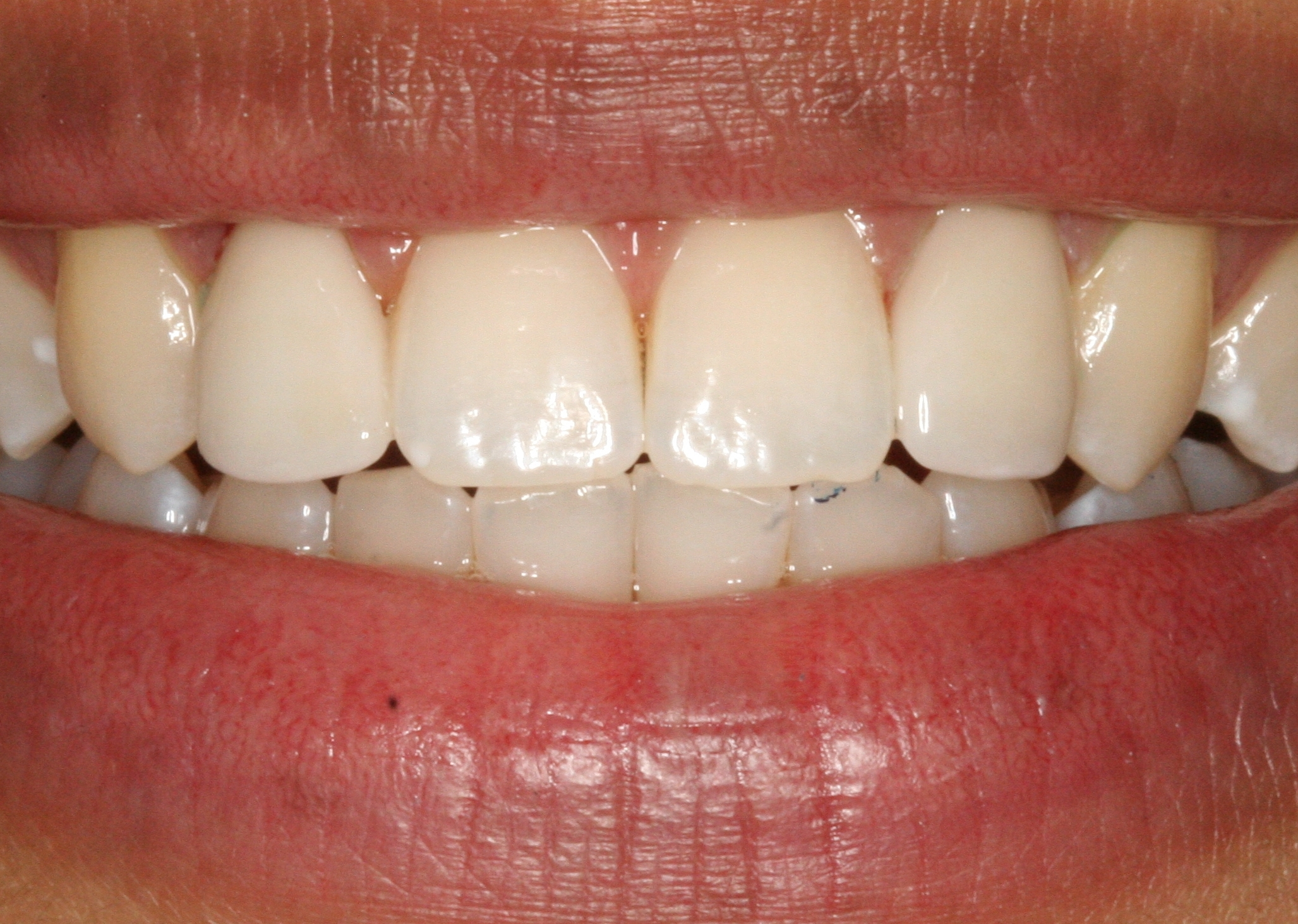 # Common Misconceptions About Teeth Types