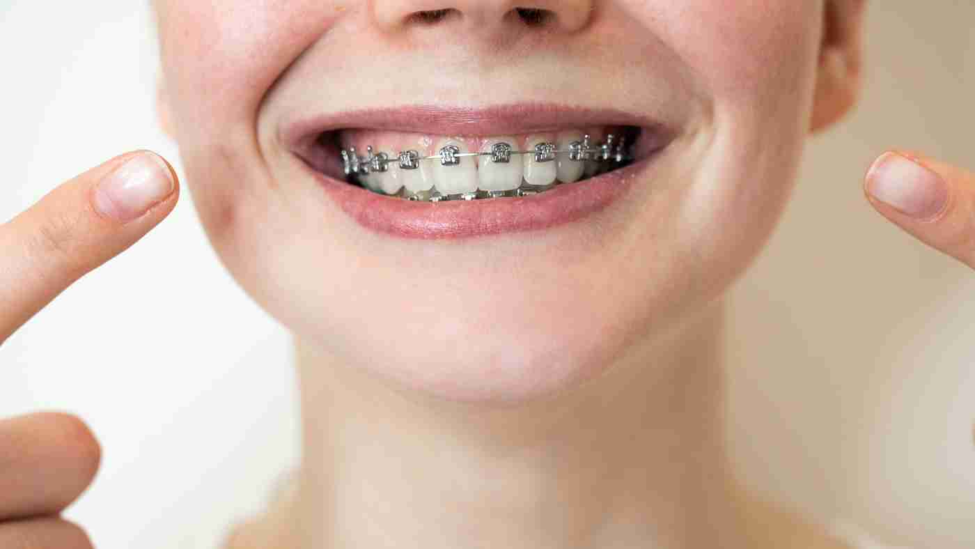 # How to Brush Your Teeth with Braces