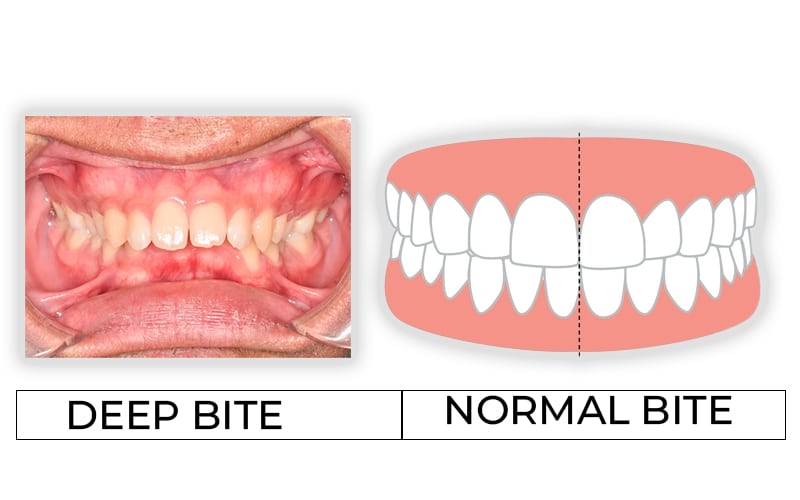 # How Does Tooth Anatomy Affect Bite and Alignment?