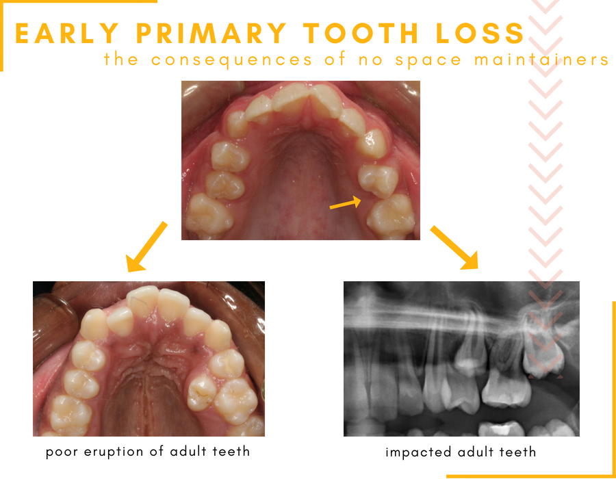 # Differences Between Baby Teeth and Adult Teeth