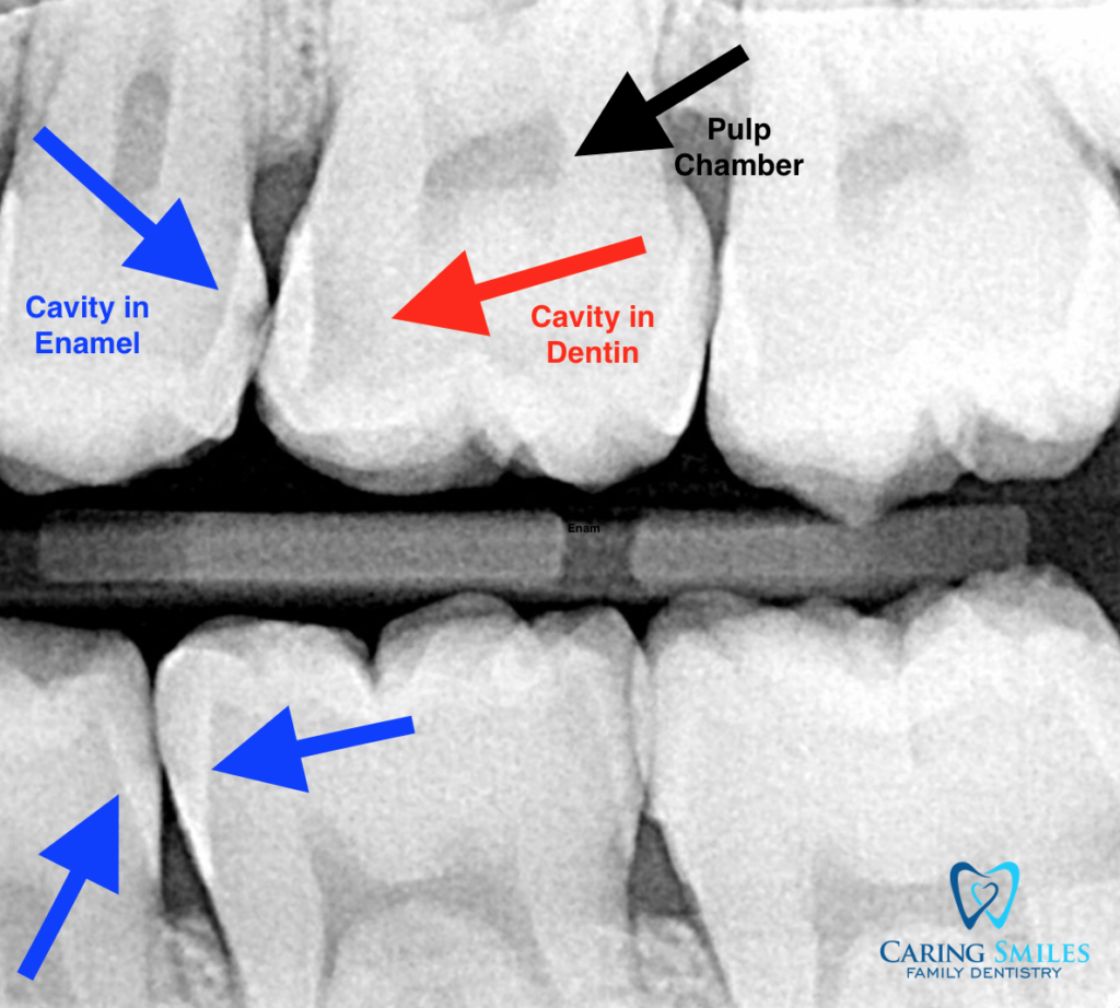 # Why Is Flossing Important for Your Oral Health?