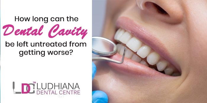 How Long Can You Leave a Cavity Untreated? Risks Explained