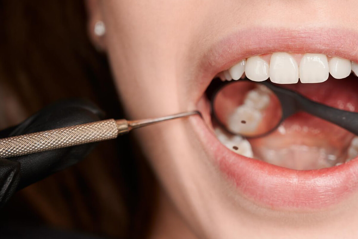 Do Cavities Heal on Their Own? The Truth About Tooth Decay