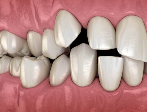 # How Do Teeth Types Affect Your Bite?