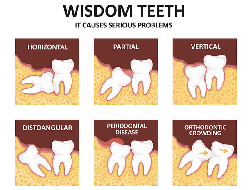 # Understanding Different Types of Teeth