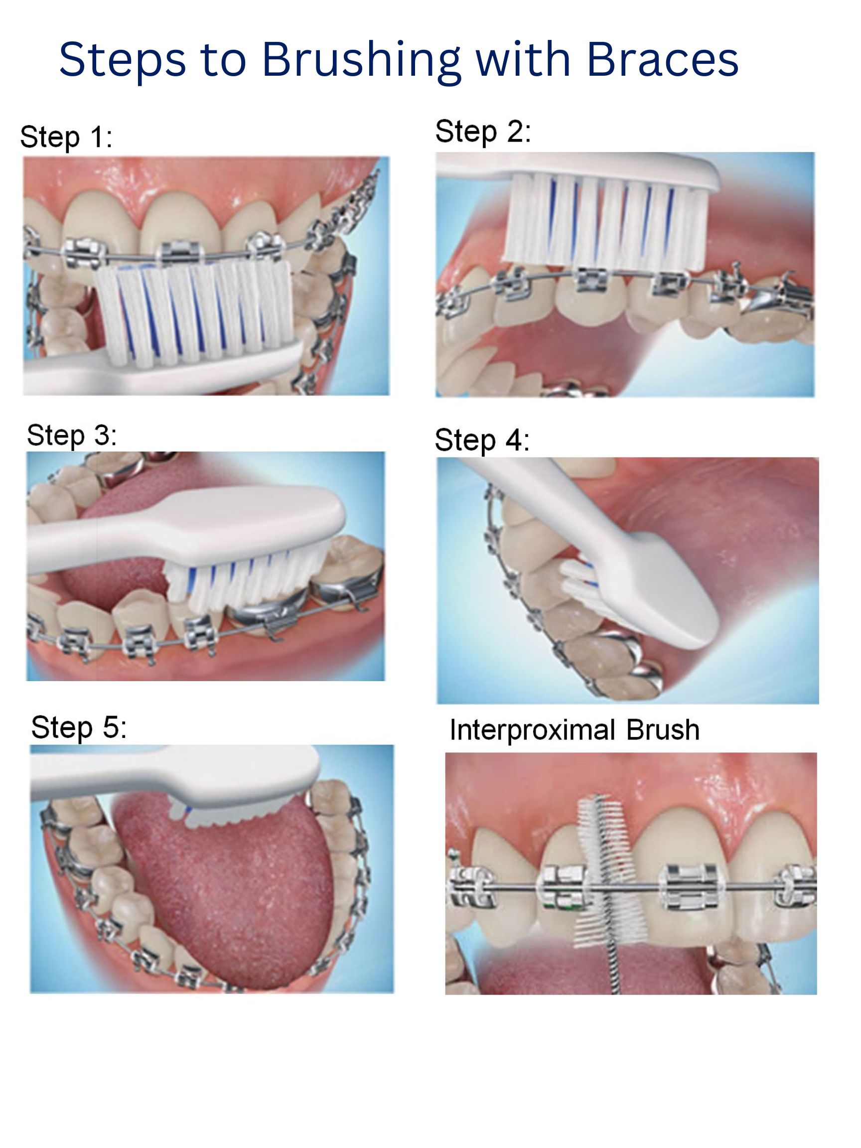 # How to Brush Your Teeth with Braces or Aligners