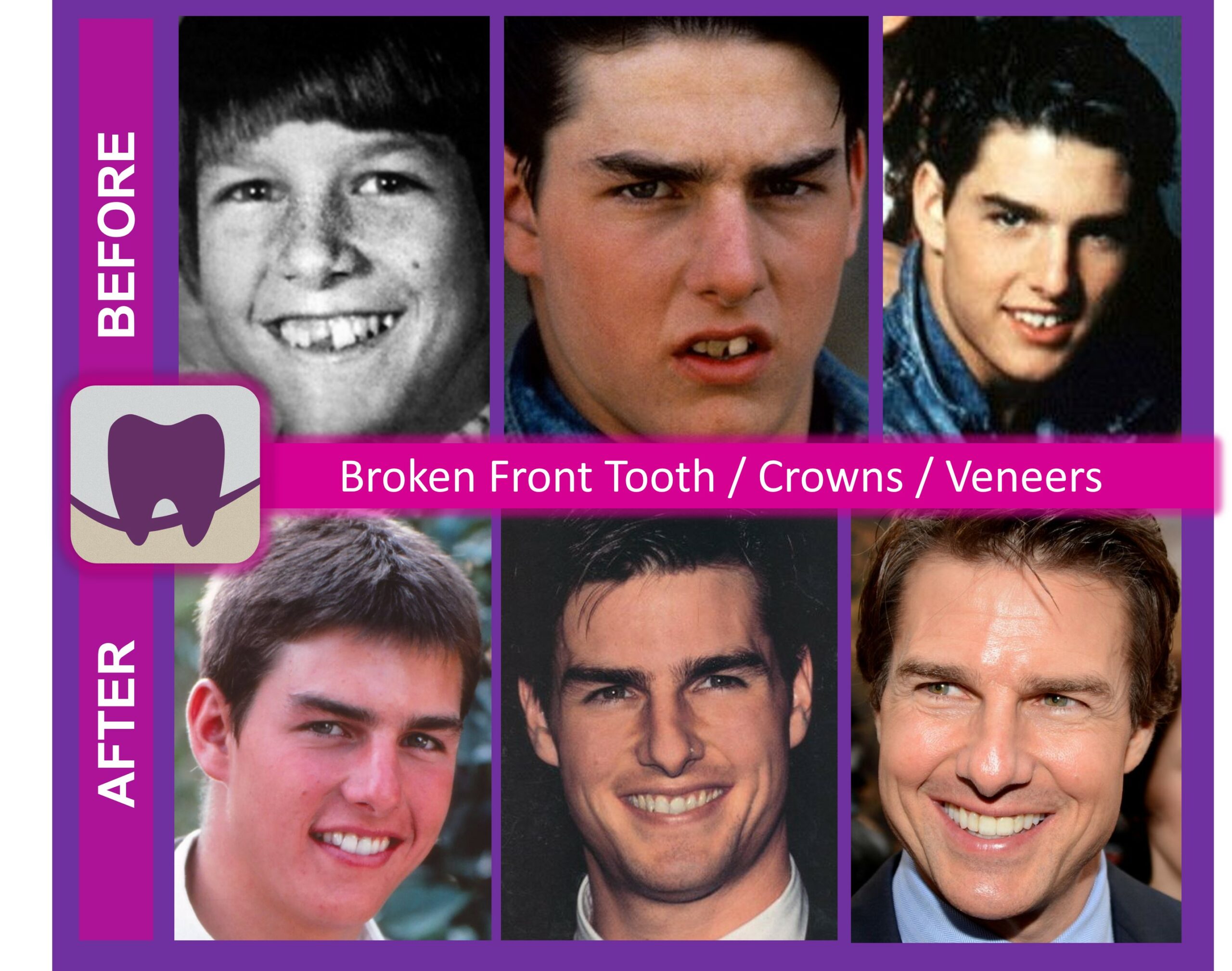 Tom Cruise teeth