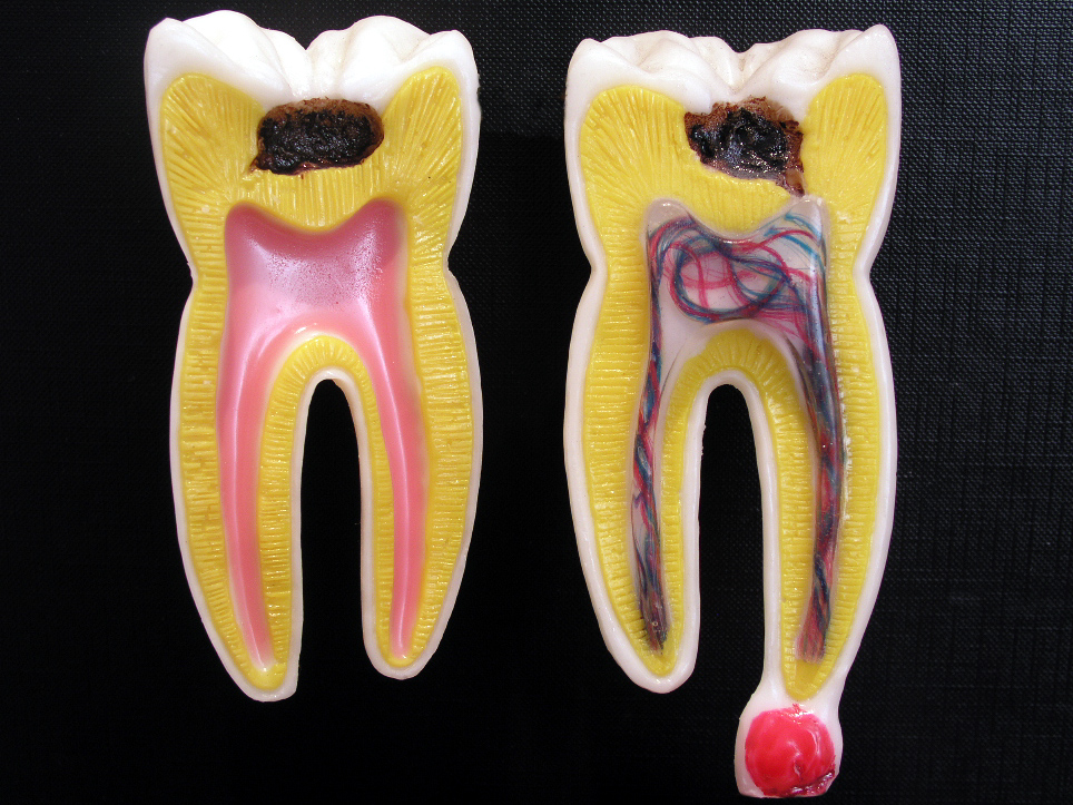 # What Is the Pulp and Its Importance in Teeth?