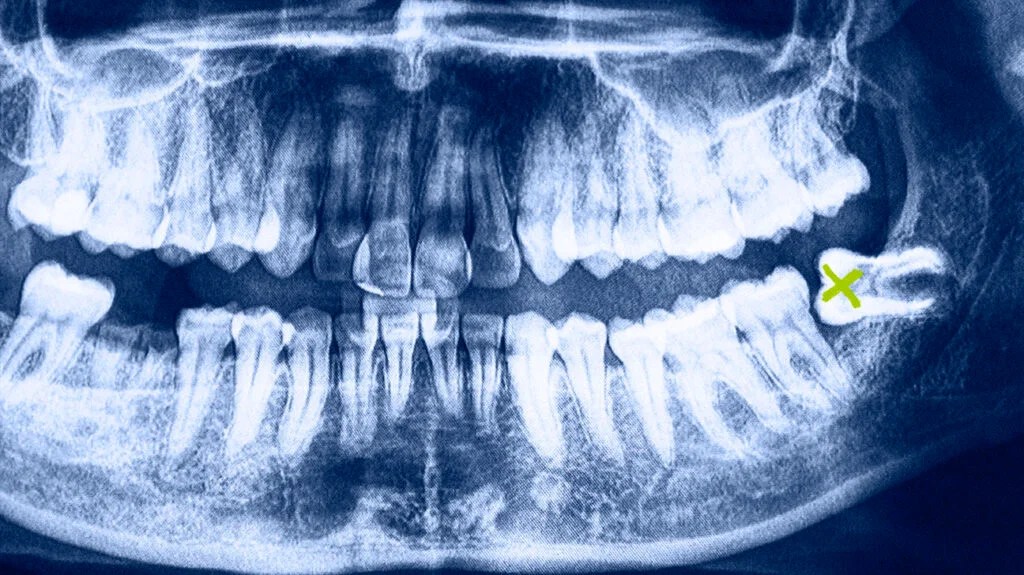 # The Role of Wisdom Teeth in Your Mouth