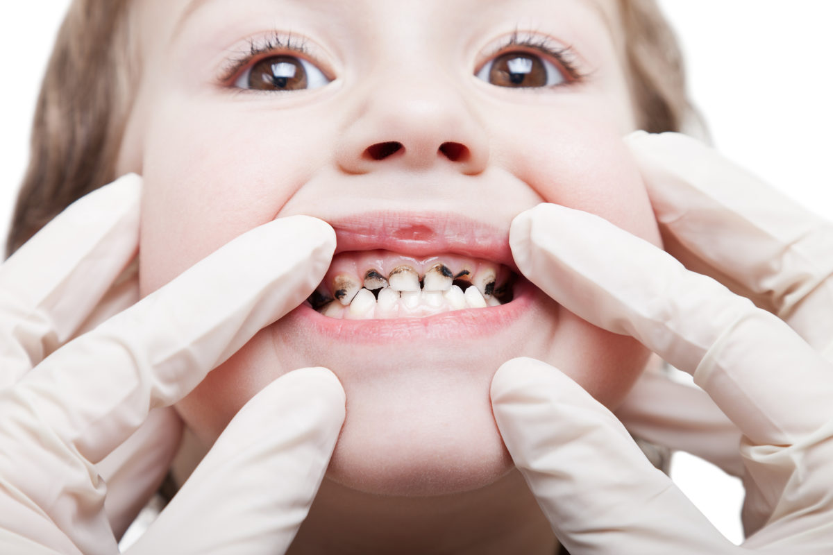 Cavities in Children: How to Protect Your Kid’s Teeth