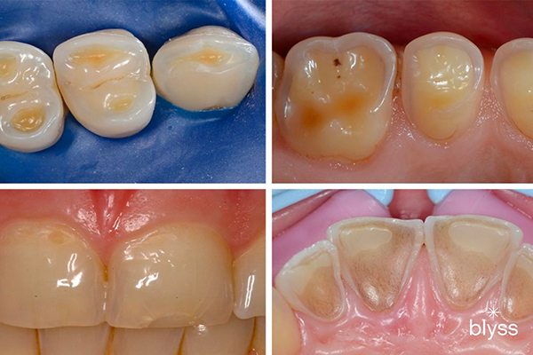 # Understanding Different Types of Teeth