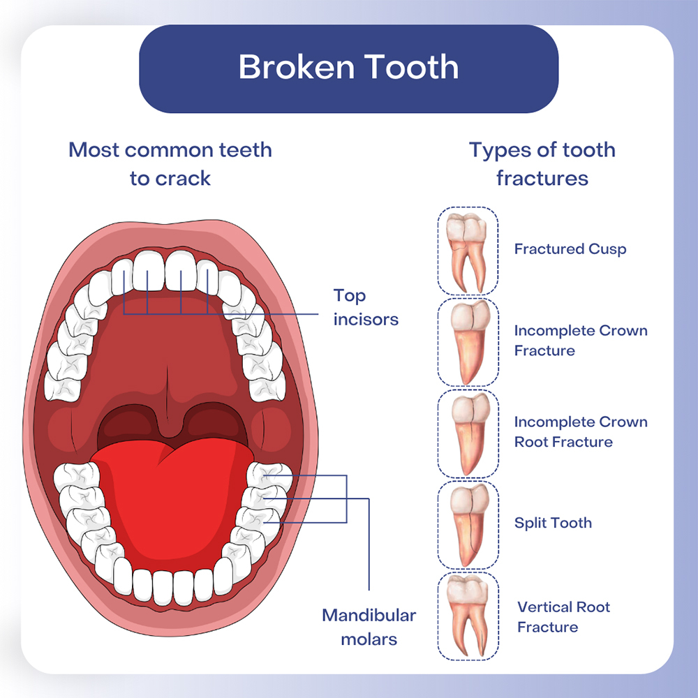 # What Are the Functions of Molars vs. Incisors?