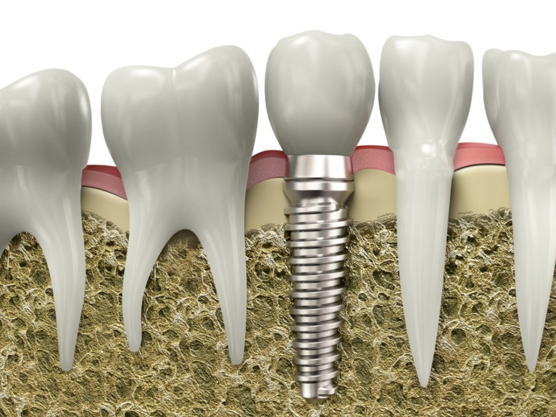 # How Are Teeth Connected to the Jaw?