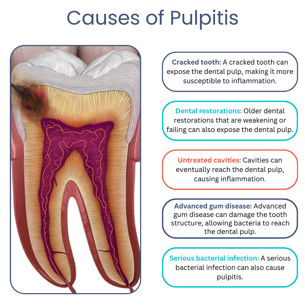 # What Is the Pulp and Its Importance in Teeth?