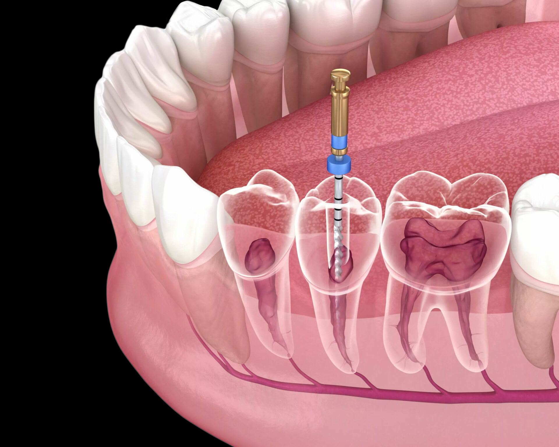 Do You Need a Root Canal? When a Cavity Becomes Serious