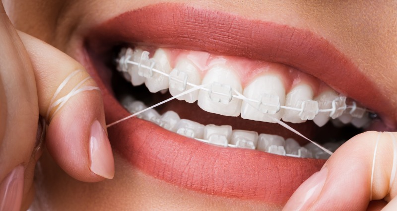 # How to Brush Your Teeth with Braces or Aligners