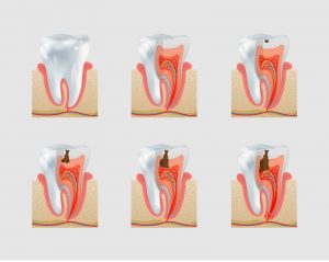 # What Are the Anatomical Features of Decayed Teeth?