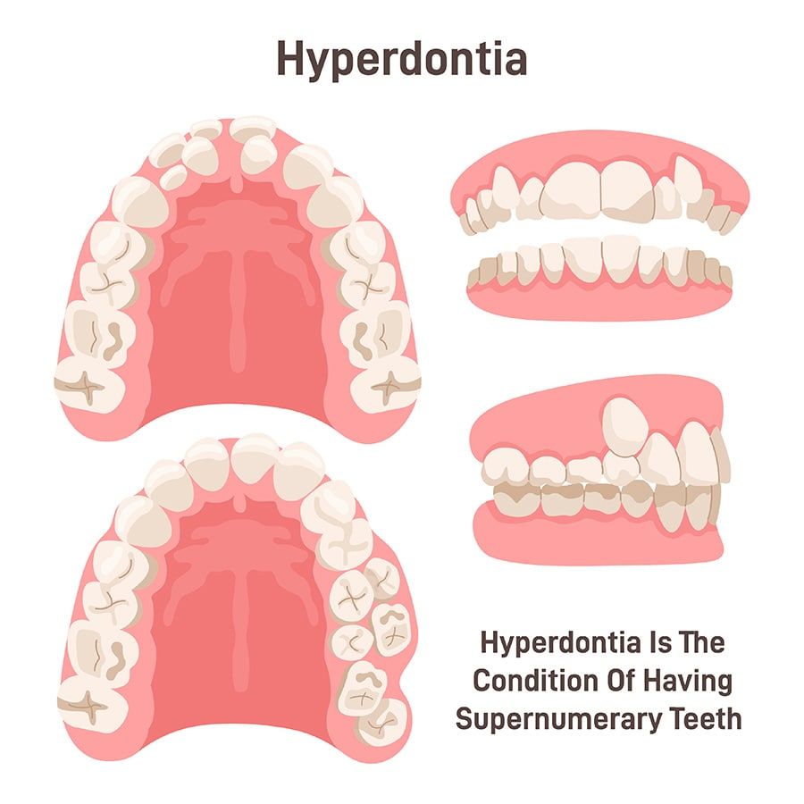 # Are There Rare Teeth Types in Humans?