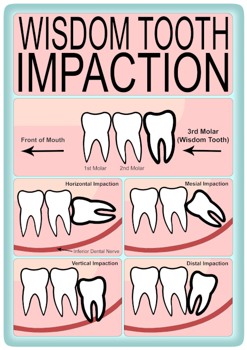 # What Are Wisdom Teeth and Their Anatomy?