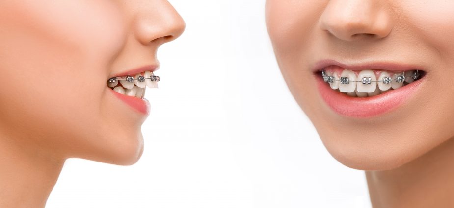 # What to Know About Tooth Types and Orthodontics