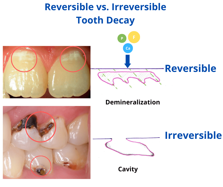 Tooth Decay vs. Cavity: What’s the Difference?