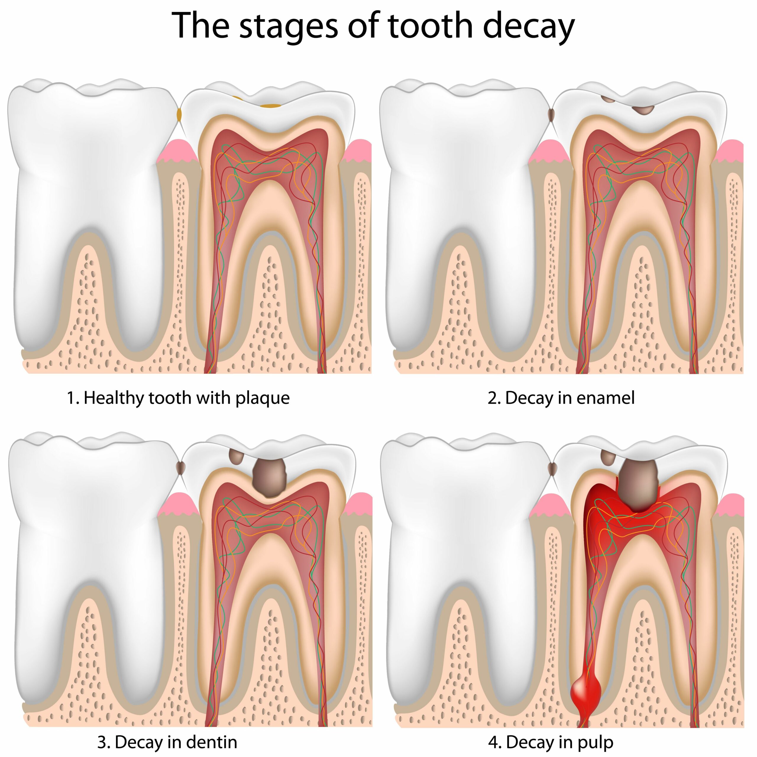 Do Cavities Heal on Their Own? The Truth About Tooth Decay