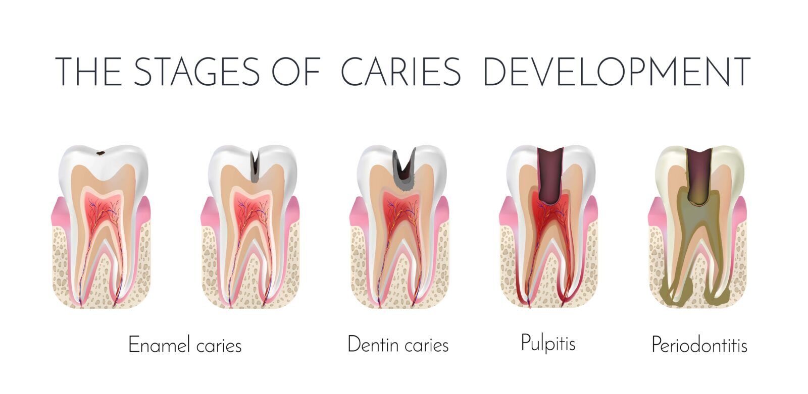 Tooth Decay vs. Cavity: What’s the Difference?