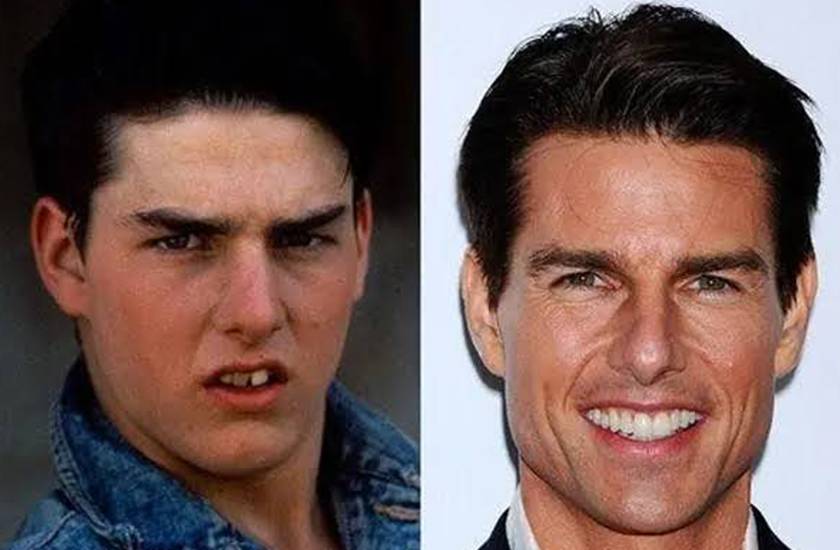 Tom Cruise teeth