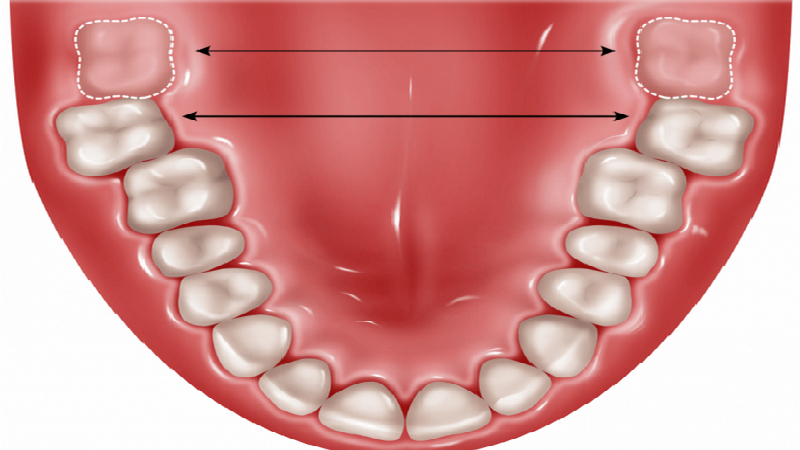 # What Are Wisdom Teeth and Their Anatomy?